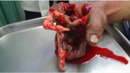 hand_kapot_vuurwerk.jpg
